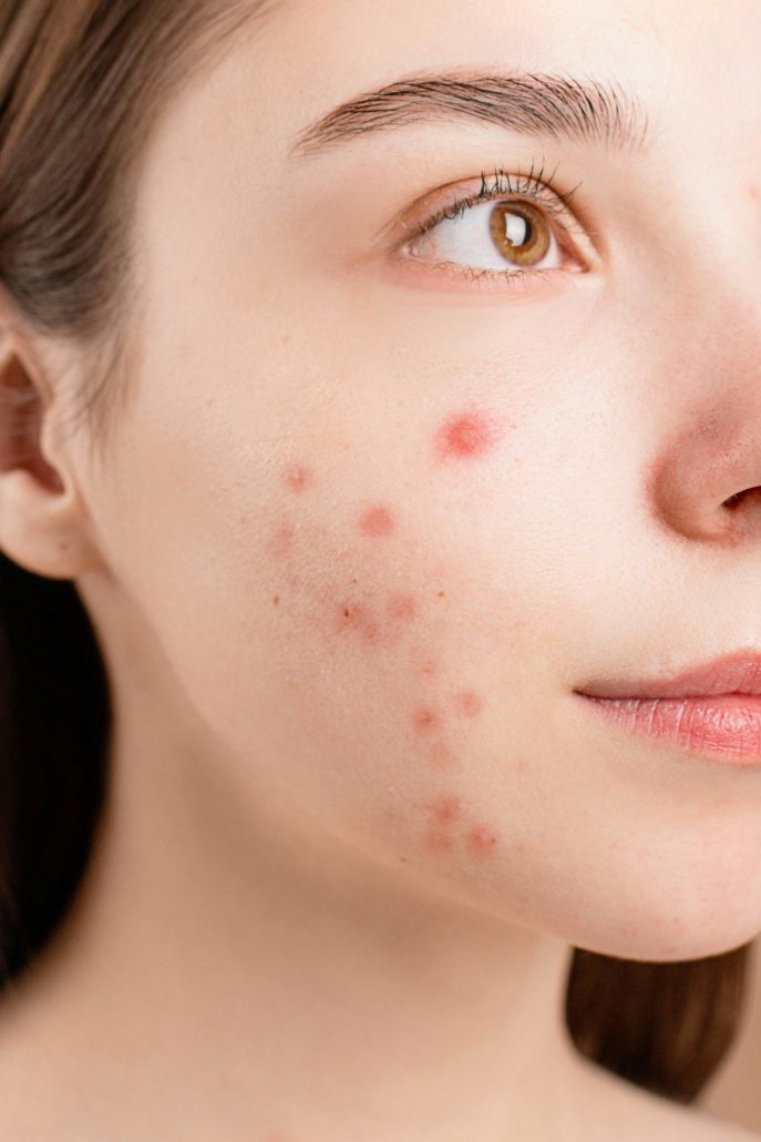 les pires conseils quand on a de l'acné. acné, peau, visage.